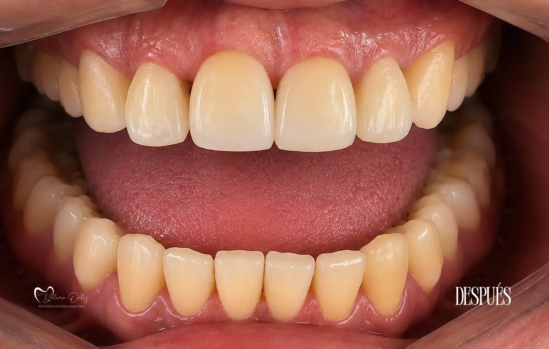 Rehabilitación estética y cambio de color — después