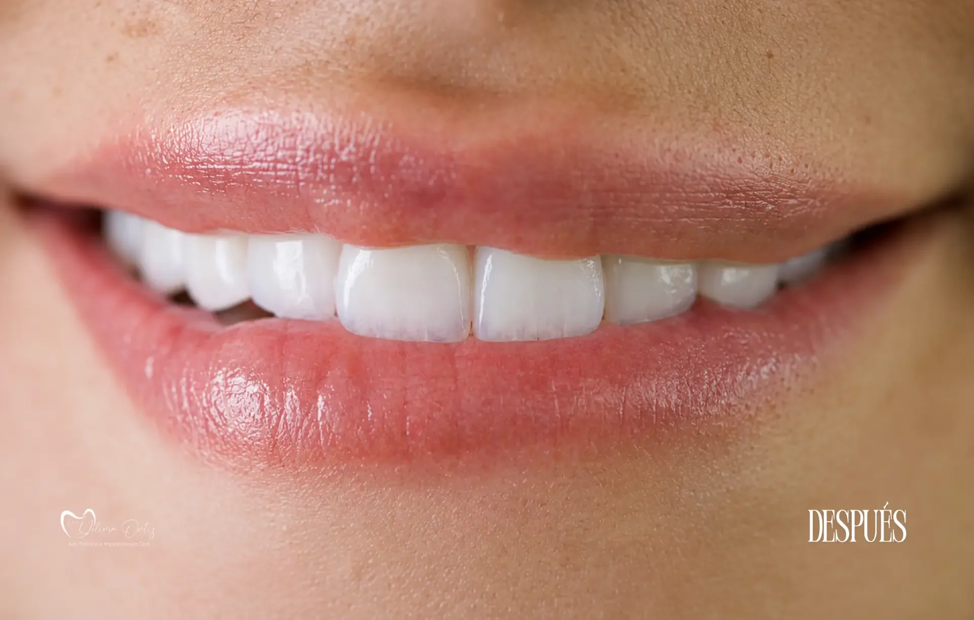 Estética dental — Yolima Ortiz Odontología