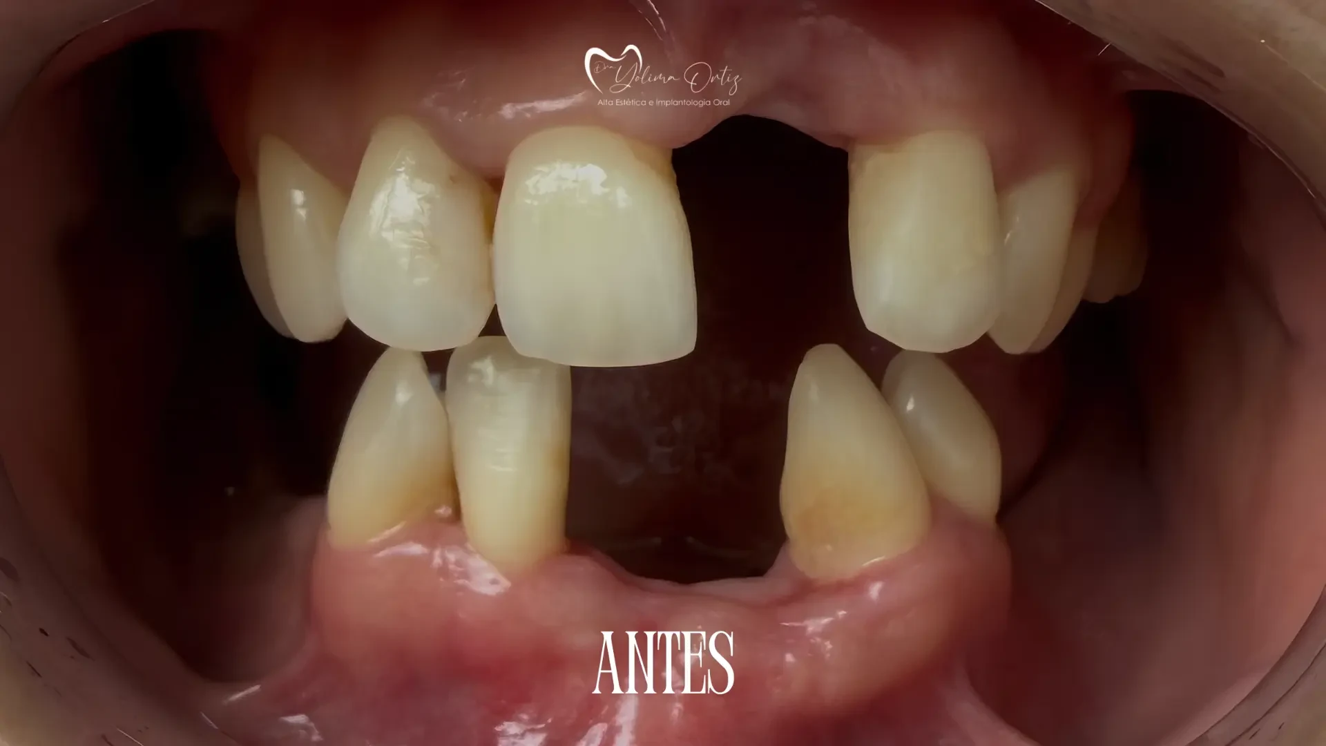 Implantes y rehabilitación oral completa — antes