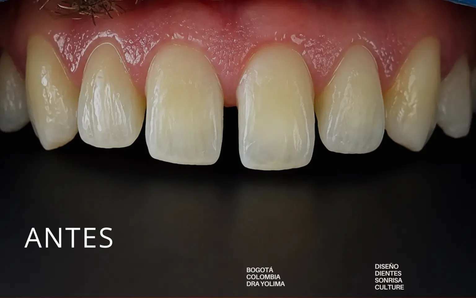 Diseño de sonrisa con carillas de porcelana — antes