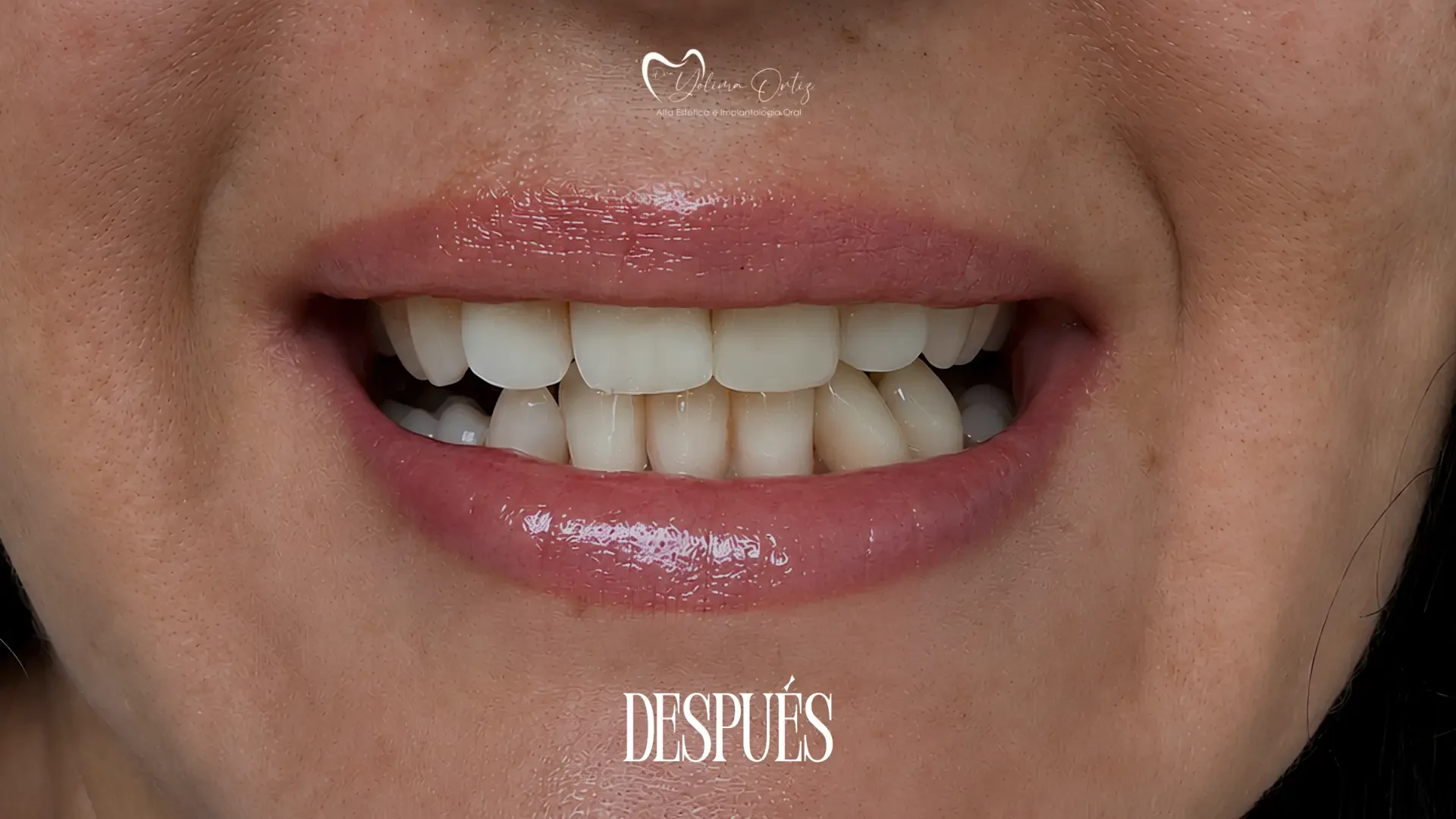 Implantes y rehabilitación oral completa — después
